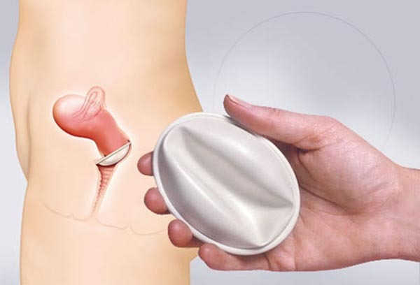 màng chắn âm đạo tránh thai