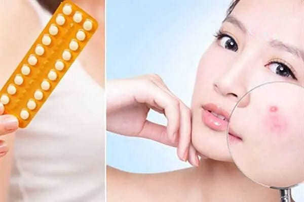 thuốc tránh thai làm đẹp da có nên dùng không?
