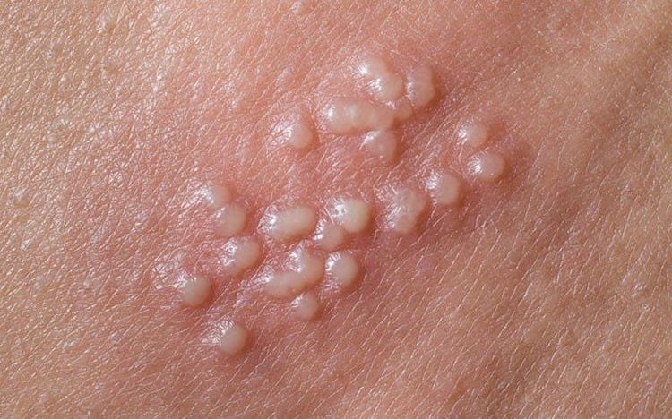BỆNH DA LIỄU Ở BỘ PHẬN SINH DỤC: DẤU HIỆU, NGUYÊN NHÂN, CÁCH ĐIỀU TRỊ 4 Herpes sinh dục