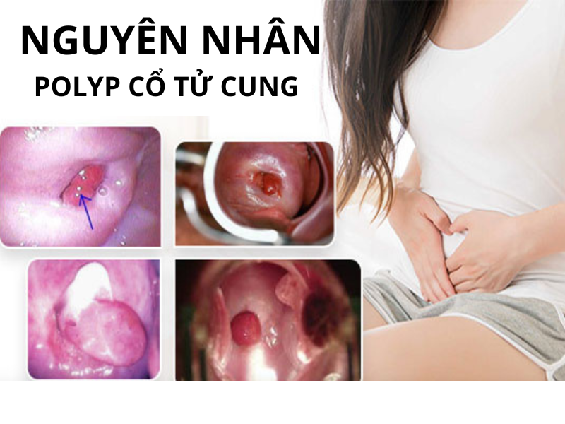 POLYP CỔ TỬ CUNG LÀ GÌ? BIỂU HIỆN CỦA BỆNH VÀ CÁCH ĐIỀU TRỊ 2 nguyen nhan polyp co tu cung