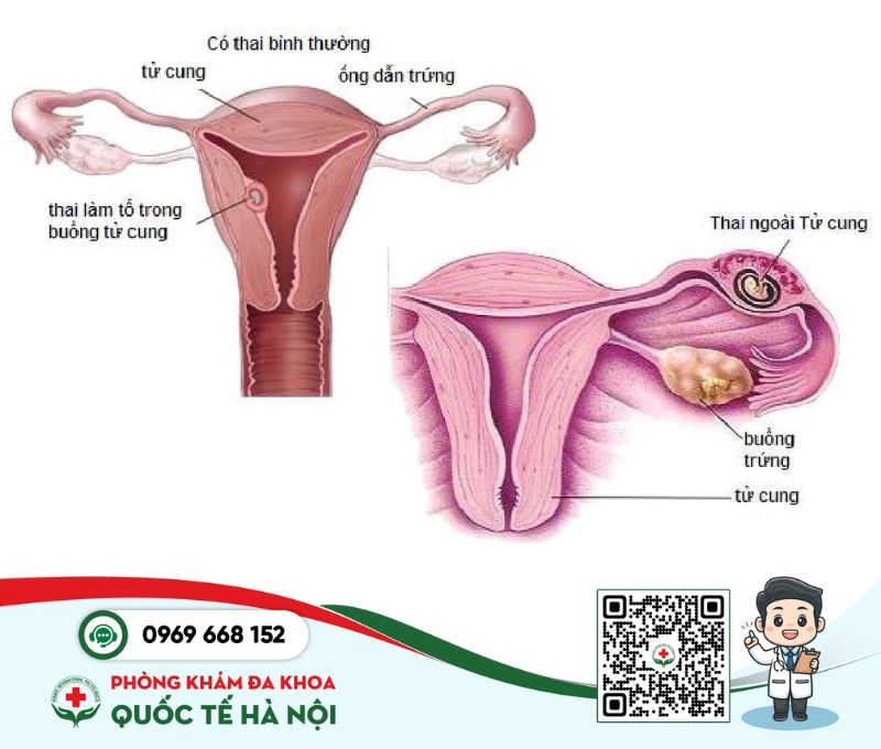 Ống dẫn trứng bị viêm nguyên nhân dẫn đến mang thai ngoài tử cung
