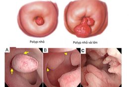 polyp-co-tu-cung-la-gi-bieu-hien-cach-dieu-tri