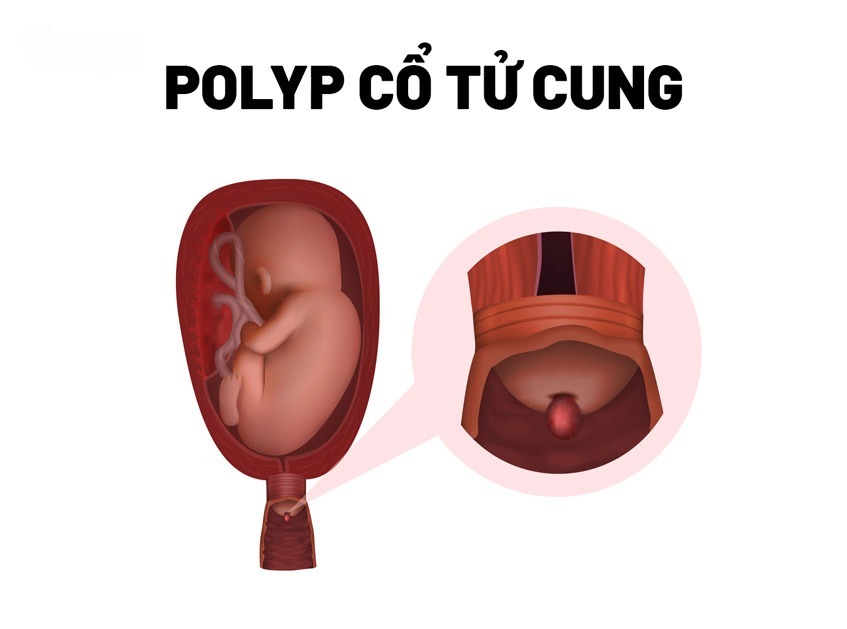 POLYP CỔ TỬ CUNG LÀ GÌ? BIỂU HIỆN CỦA BỆNH VÀ CÁCH ĐIỀU TRỊ 3 polyp co tu cung khi mang thai