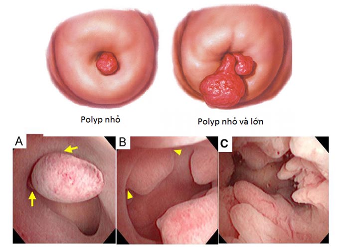 POLYP CỔ TỬ CUNG LÀ GÌ? BIỂU HIỆN CỦA BỆNH VÀ CÁCH ĐIỀU TRỊ 1 polyp co tu cung