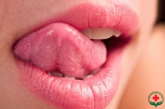 Cuống lưỡi nổi mụn đỏ là bị gì 