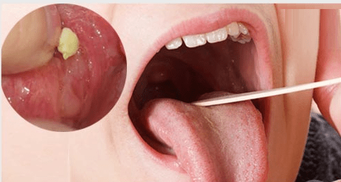 Mọc mụn trắng ở dưới lưỡi- triệu chứng của sỏi amidan