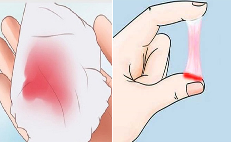 NHẬN BIẾT KHÍ HƯ BÌNH THƯỜNG VÀ KHÍ HƯ BỆNH LÝ 5 Khí hư màu hồng