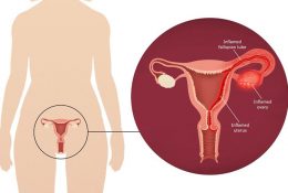 chua-viem-buong-trung-bang-dan-gian