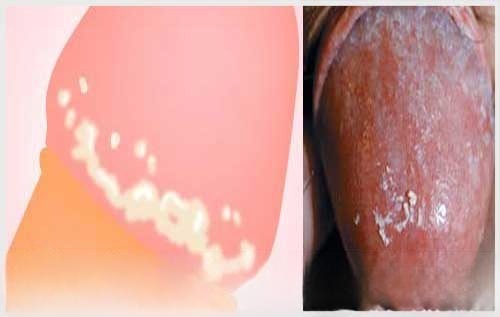 NẤM BAO QUY ĐẦU: NGUYÊN NHÂN, DẤU HIỆU VÀ CÁCH ĐIỀU TRỊ HIỆU QUẢ 4 dau hieu nam duong vat