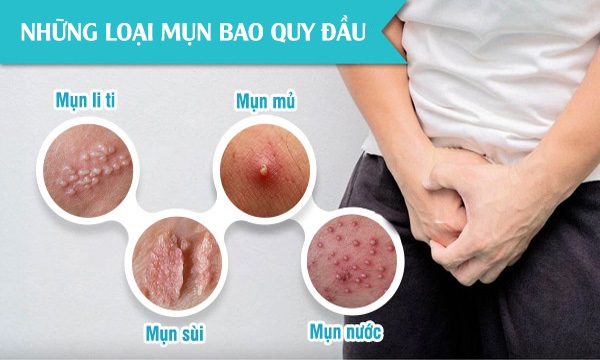 THUỐC TRỊ MỤN Ở BAO QUY ĐẦU LOẠI NÀO HIỆU QUẢ NHẤT ? 1 mun bao quy dau 1