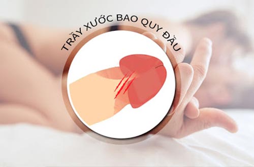 RÁCH BAO QUY ĐẦU CÓ TỰ KHỎI KHÔNG ? 3 rach 2