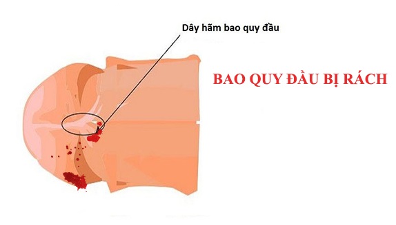 RÁCH BAO QUY ĐẦU CÓ TỰ KHỎI KHÔNG ? 1 rach da