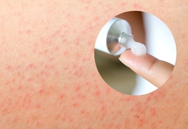 TRỊ VIÊM NANG LÔNG VÙNG KÍN TẠI NHÀ AN TOÀN HIỆU QUẢ 5 thuoc boi viem nang long