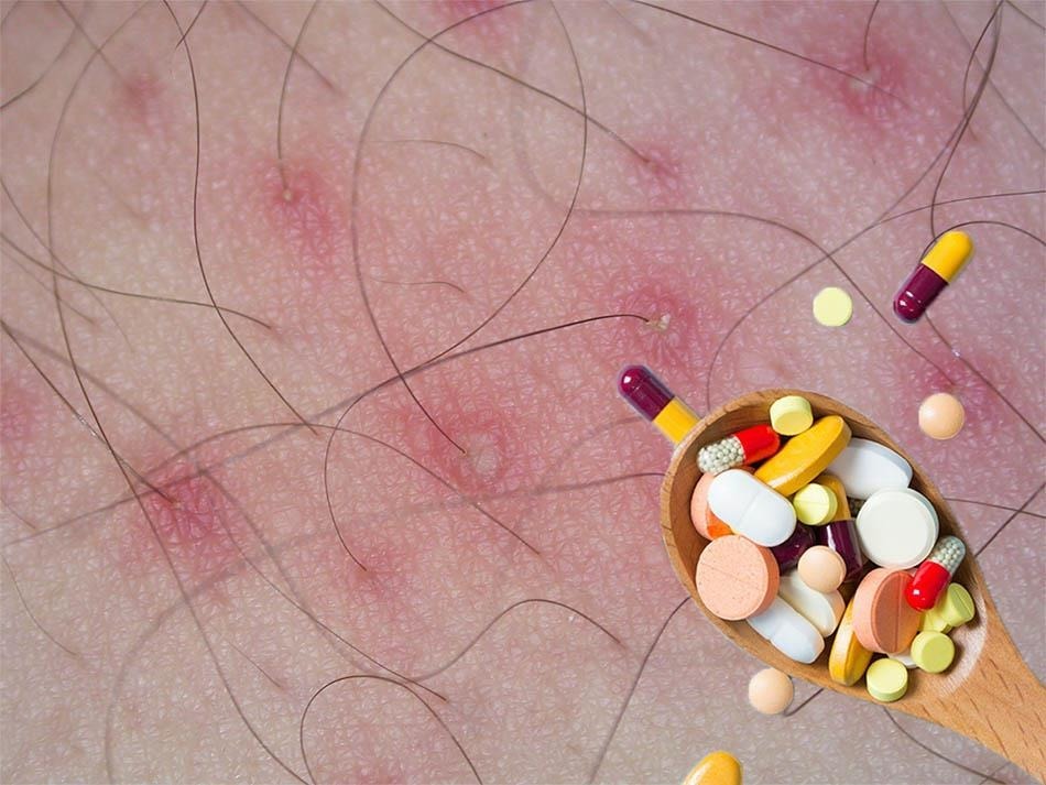 THUỐC TRỊ VIÊM NANG LÔNG VÙNG KÍN: GIẢI PHÁP AN TOÀN CHO CHỊ EM PHỤ NỮ 3 thuoc tri viem nang long 6604