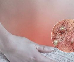 thuoc-tri-viem-nang-long-vung-kin