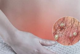 thuoc-tri-viem-nang-long-vung-kin