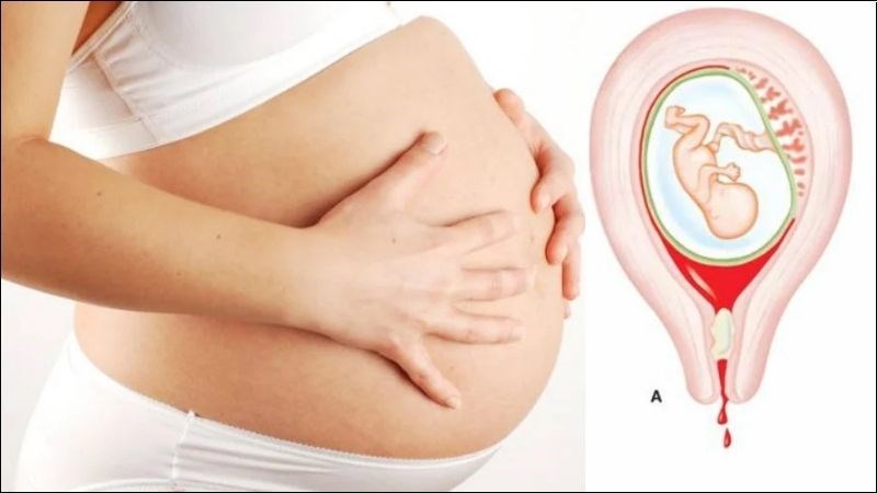 CHẢY MÁU ÂM ĐẠO KHI MANG THAI CÓ NGUY HIỂM KHÔNG? 1 Chảy máu âm đạo khi mang thai