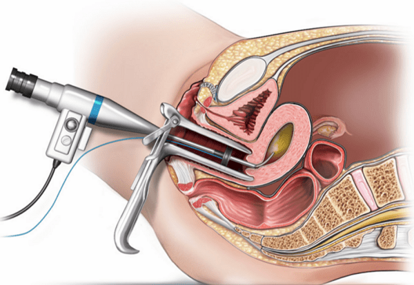 chi phí cắt polyp cổ tử cung phụ thuộc phương pháp tiểu phẫu