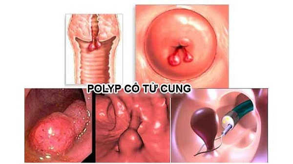 chi phí cắt polyp cổ tử cung phụ thuộc tình trạng khối u