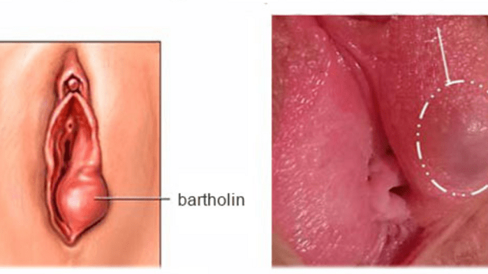 hình ảnh viêm tuyến bartholin