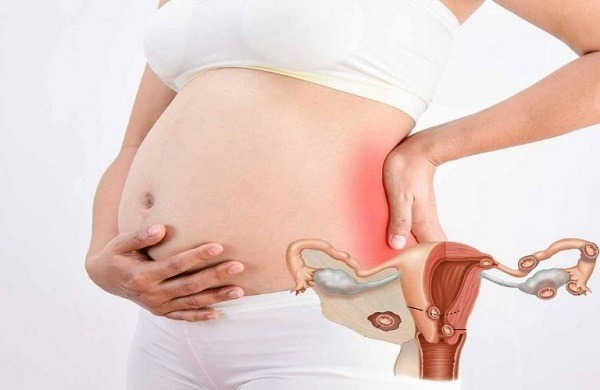 viêm vùng chậu khi mang thai