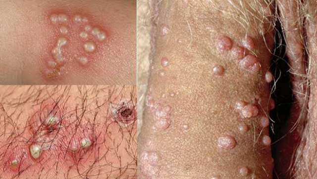 DƯƠNG VẬT BỊ TRÓC DA: TÌM HIỂU 6 NGUYÊN NHÂN GÂY RA 3 Hình ảnh mụn rộp sinh dục