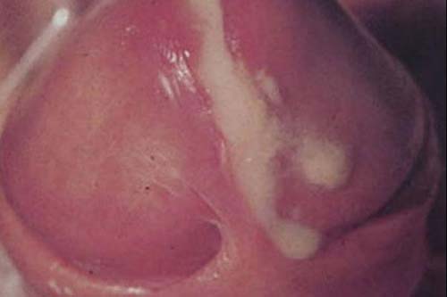 DƯƠNG VẬT CHẢY DỊCH VÀNG LÀ DẤU HIỆU BỆNH GÌ? 1 duong vat chay dich vang