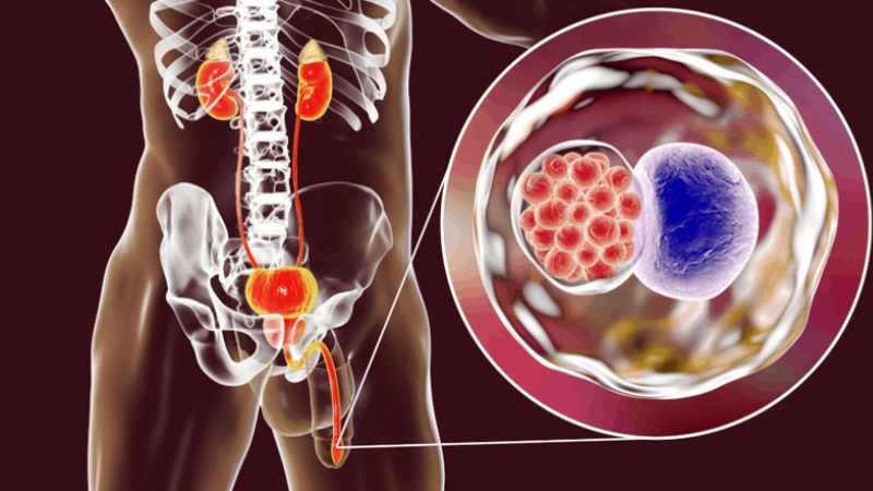 duong vat co mui hoi do viem duong tiet nieu