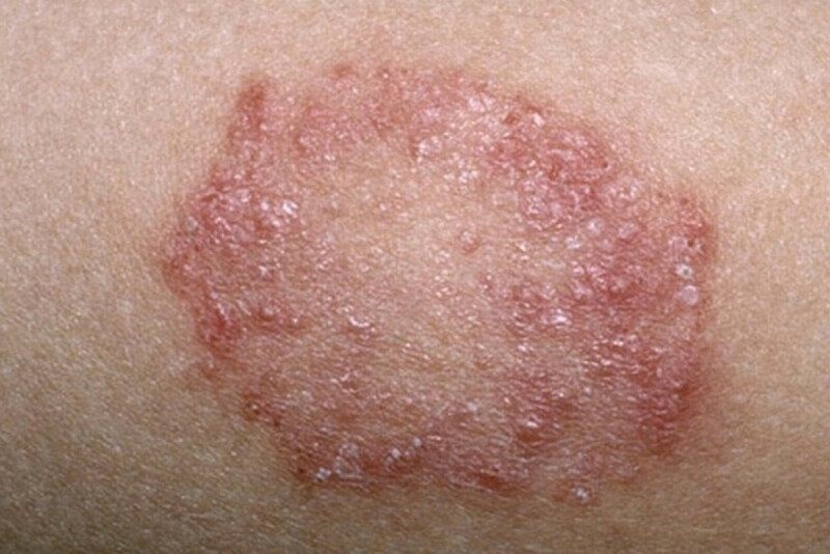 DƯƠNG VẬT BỊ TRÓC DA: TÌM HIỂU 6 NGUYÊN NHÂN GÂY RA 4 Tổn thương giang mai
