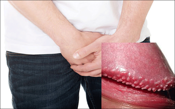 THUỐC TRỊ HẠT NGỌC DƯƠNG VẬT CÓ THẬT SỰ CẦN THIẾT? 1 Hạt ngọc dương vật