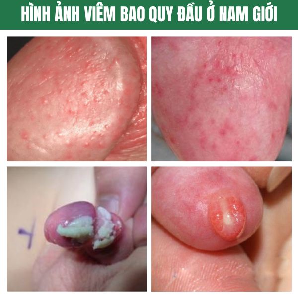 hinh anh viem bao quy dau o nam
