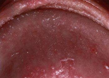 DƯƠNG VẬT BỊ TRÓC DA: TÌM HIỂU 6 NGUYÊN NHÂN GÂY RA 3 nhiem nam candida 2