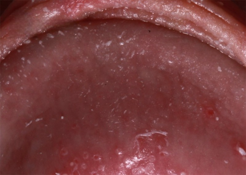 NGỨA BAO QUY ĐẦU: NGUYÊN NHÂN, MỨC ĐỘ NGUY HIỂM VÀ CÁCH ĐIỀU TRỊ 2 nhiem nam candida 2