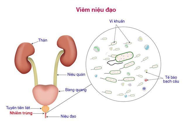 viem nieu dao khien duong vat co mui hoi