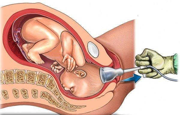 các biện pháp xử lý khi bị thai lưu