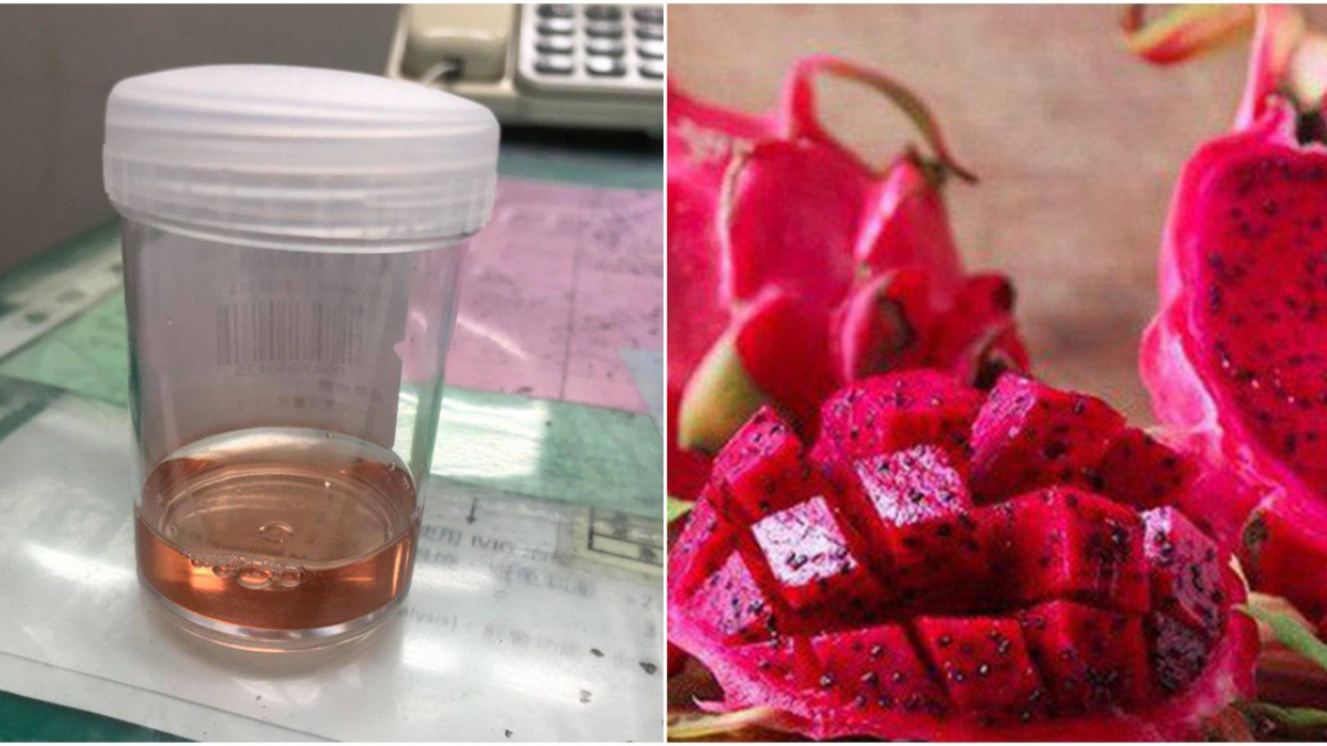 ĐI TIỂU RA MÁU - DẤU HIỆU CẢNH BÁO BỆNH LÝ NGUY HIỂM 2 Ăn thực phẩm có màu đỏ khiến nước tiểu màu hồng như đi tiểu ra máu