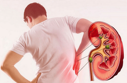 ĐI TIỂU RA MÁU - DẤU HIỆU CẢNH BÁO BỆNH LÝ NGUY HIỂM 5 Sỏi thận - Nguyên nhân hàng đầu gây đi tiểu ra máu