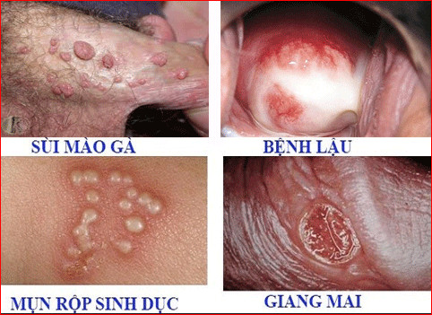 ĐI TIỂU RA MÁU - DẤU HIỆU CẢNH BÁO BỆNH LÝ NGUY HIỂM 6 benh lay truyen qua duong tinh duc