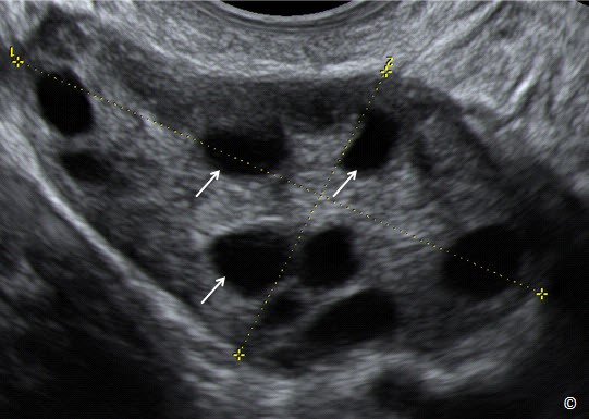 CHỮA ĐA NANG BUỒNG TRỨNG DÂN GIAN: 6 CÁCH PHỔ BIẾN HIỆN NAY 1 buong trung da nang