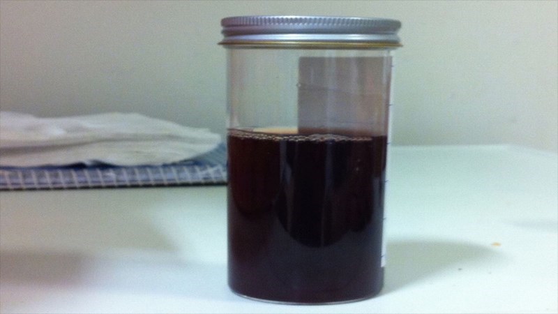 Bảng màu nước tiểu - Nước tiểu màu nâu đen, nâu sẫm