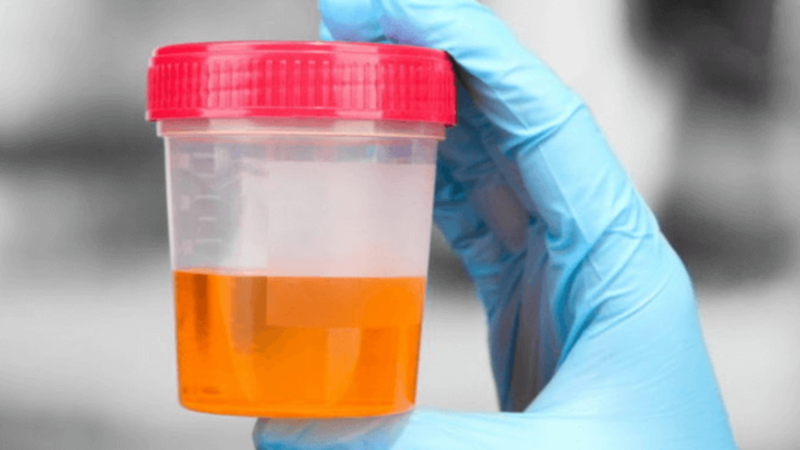 Bảng màu nước tiểu - Nước tiểu màu cam, vàng đậm