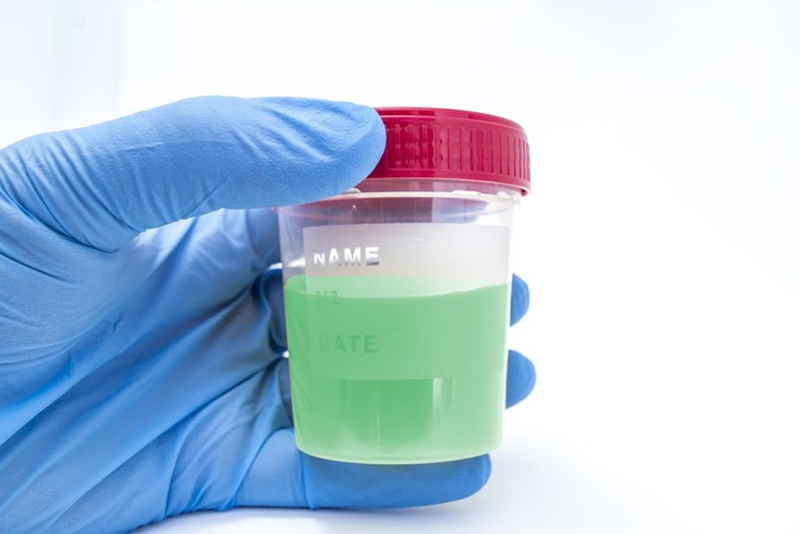 Bảng màu nước tiểu - Nước tiểu màu xanh