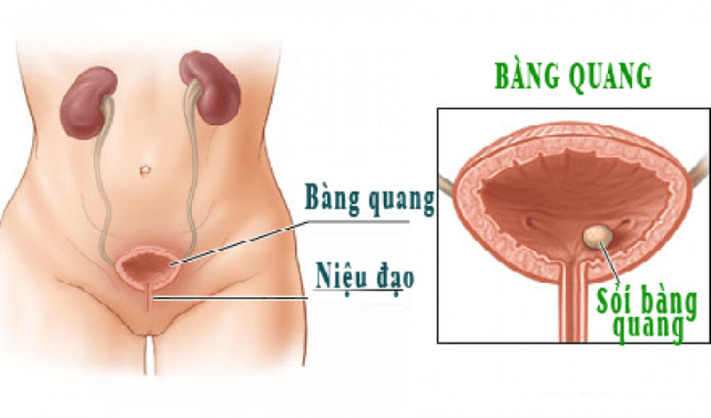 Nước tiểu có màu hồng do mắc bệnh bàng quang
