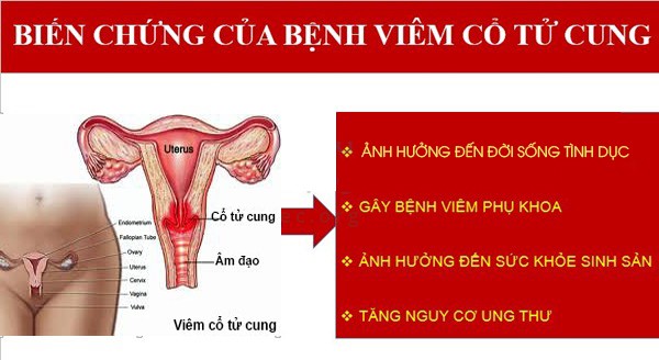 TỔNG HỢP KIẾN THỨC TỪ A - Z VỀ VIÊM CỔ TỬ CUNG 3 viem ctc nguy hiem tn