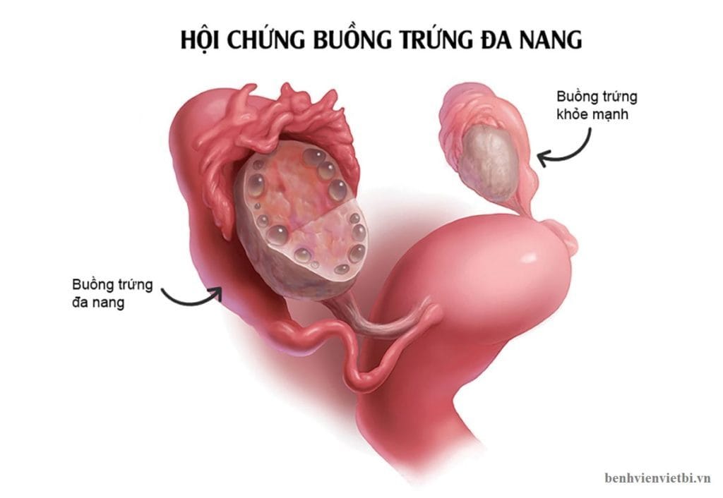 CHẬM KINH ĐAU BỤNG LÂM RÂM LÀ DẤU HIỆU BỆNH GÌ? 8 hoi chung buong trung da nang la gi 1024x706 1