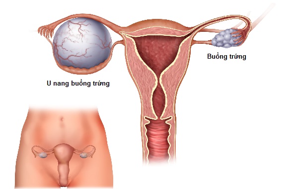 DẤU HIỆU U NANG BUỒNG TRỨNG LÀNH TÍNH VÀ CÁCH XỬ LÝ 1 U nang buồng trứng lành tính