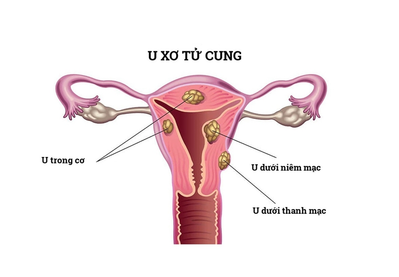 CHẬM KINH ĐAU BỤNG LÂM RÂM LÀ DẤU HIỆU BỆNH GÌ? 5 u xo tu cung