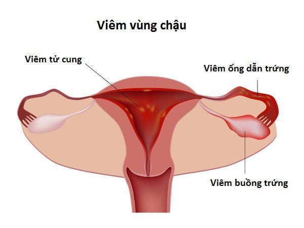 CHẬM KINH ĐAU BỤNG LÂM RÂM LÀ DẤU HIỆU BỆNH GÌ? 3 viem vung chau