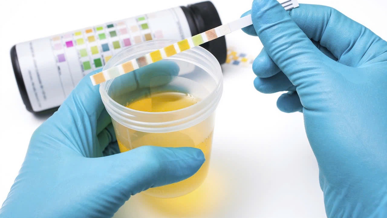 Nước tiểu có mùi hôi là bị làm sao