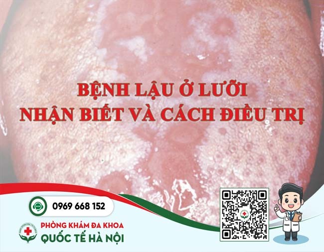 bệnh lậu ở lưỡi